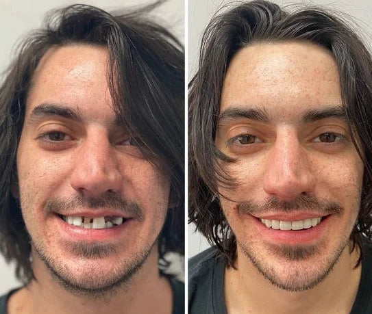 DentaLås™ Termoplastiskt Proteslim