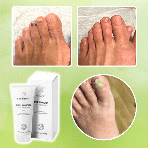 SvampFri™ Nagelsvampbehandling