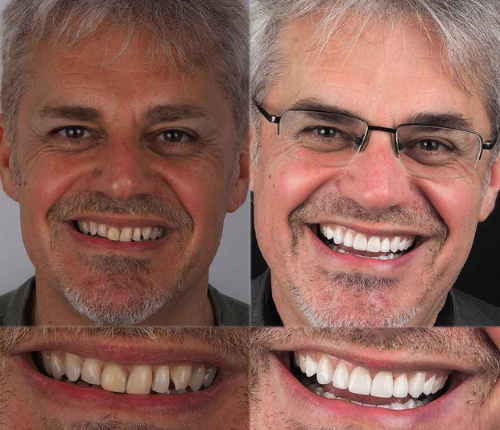 DentaLås™ Termoplastiskt Proteslim